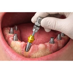 Dentaltech Multi Unit Straight Abutment Driver - Osstem Compatible - 2