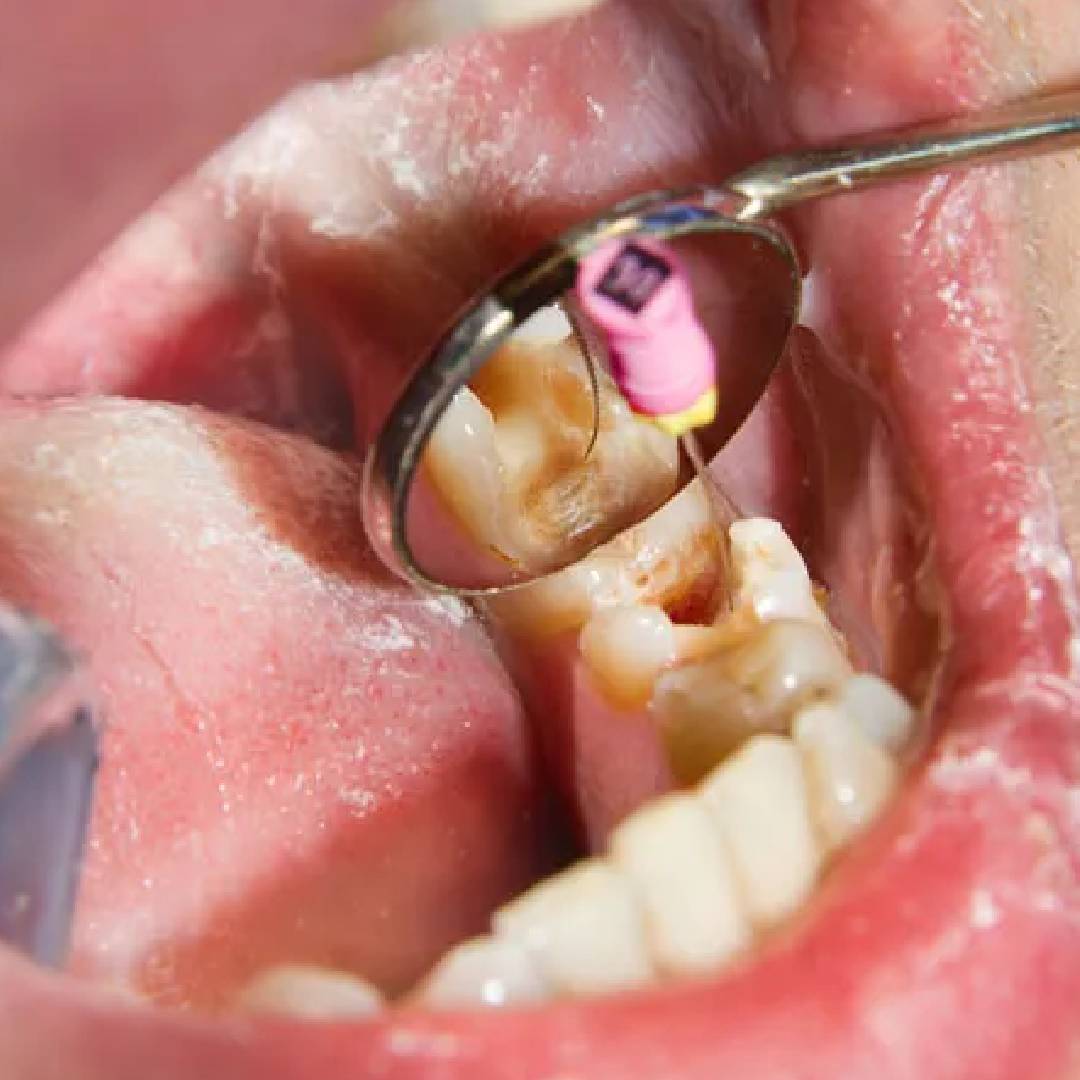 Waldent K-Flex Files 25mm #6