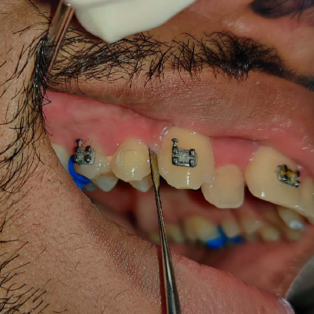 GDC Periotomes Flexi (PTF3)