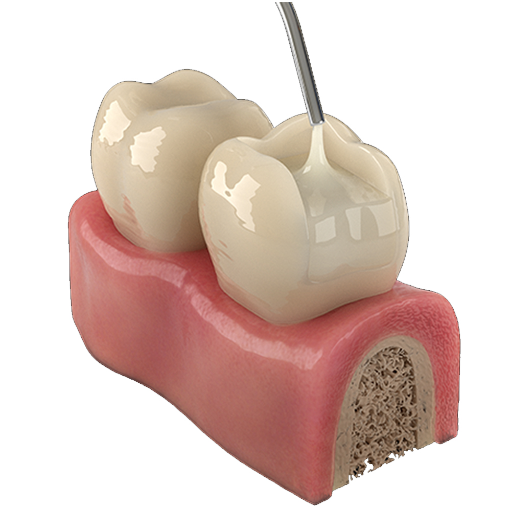 Prime Dental Restorite Bulk Fill (Flowable) - Universal Shade