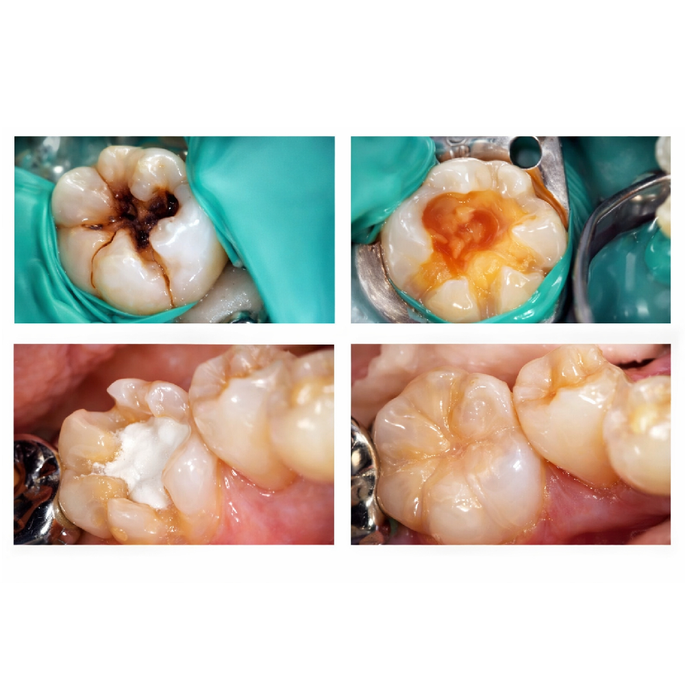 DPI MTA Putty Mineral Trioxide Aggregate