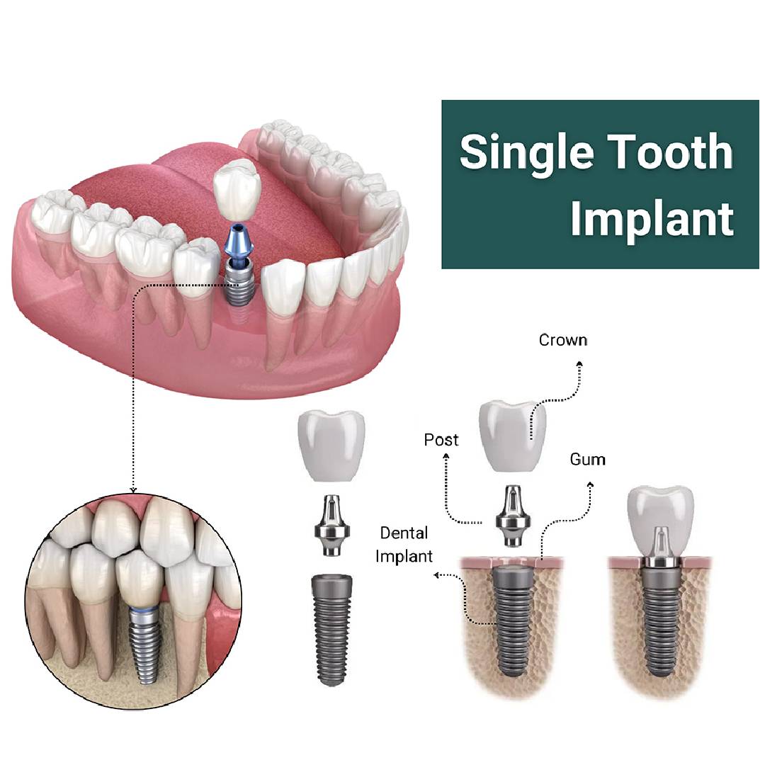 Apex Konnect Dental Implants 5.0mm