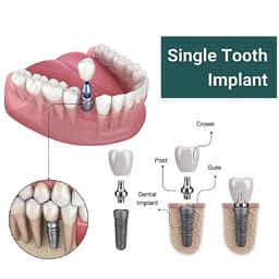 Apex Konnect Dental Implants 5.0mm - 10