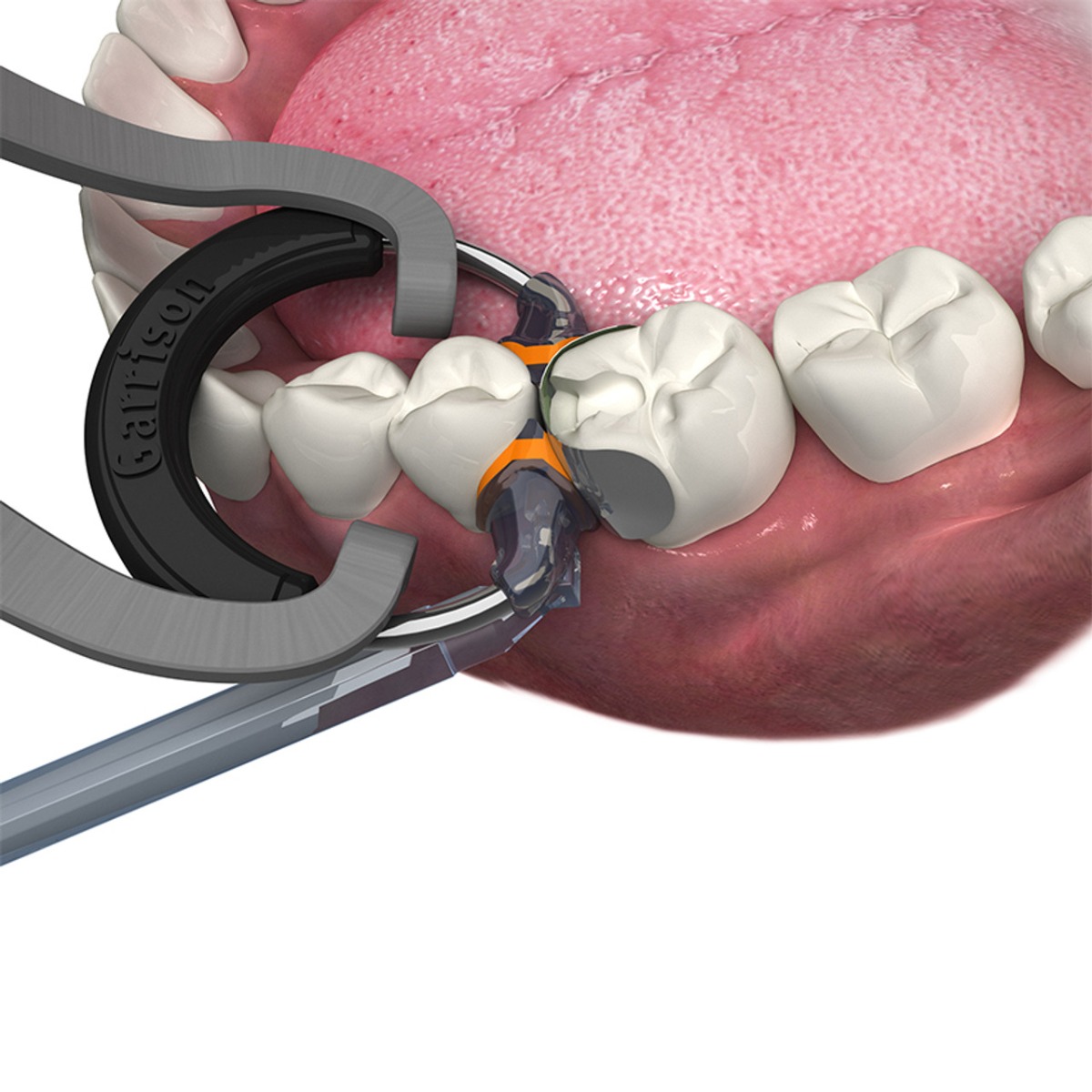 Garrison Dental Composi-Tight 3DXR Sectional Matrix Kit 3D-KFF-10
