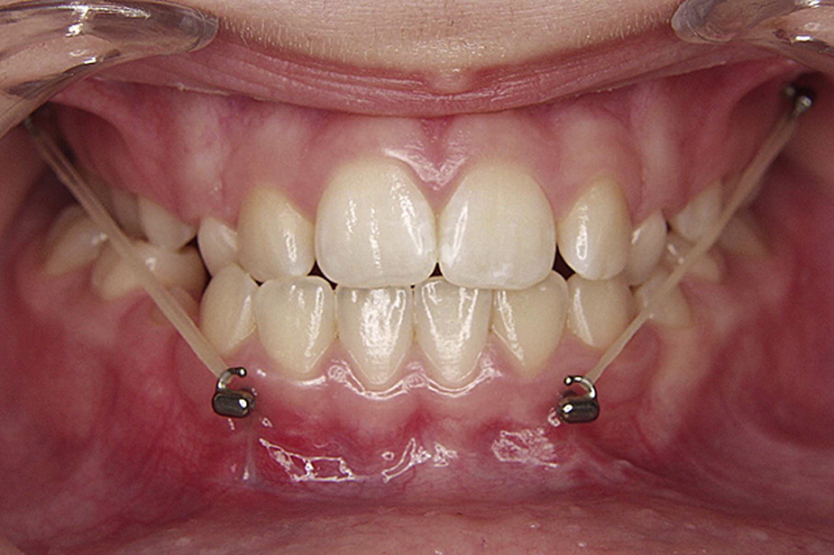 Penta Ortho Intraoral Elastics - size 5/8 -3.5 Oz (Short Expiry 04-2026)