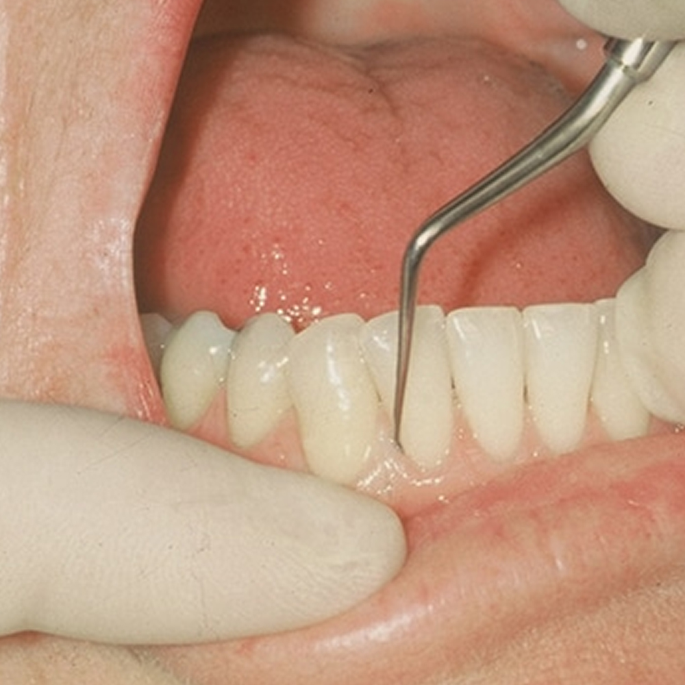 GDC Hirschfeld File - Mesial/Distal #6 (Fh5/11)