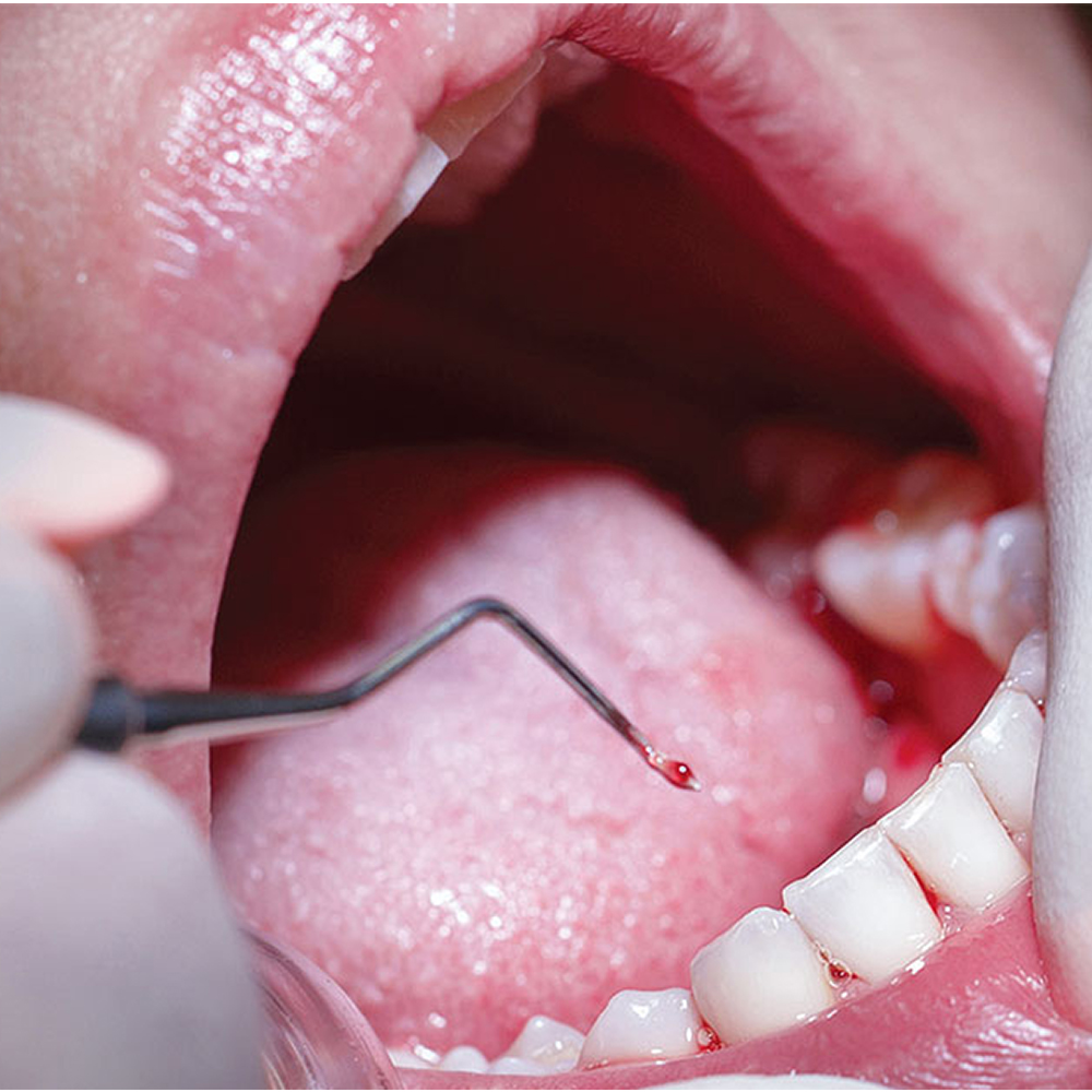 GDC Hirschfeld File - Mesial/Distal #6 (Fh5/11)