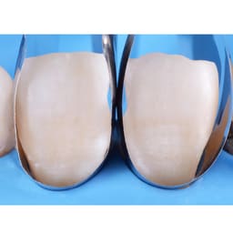 HN Dental Master Matrix Complete Sectional Matrix System Kit - 6