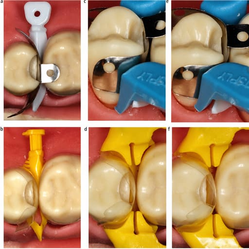 HN Dental Master Matrix Complete Sectional Matrix System Kit