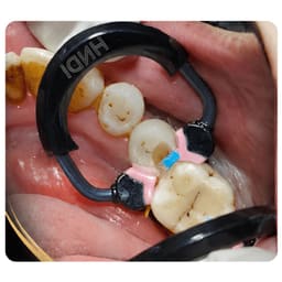 HN Dental Matrix Master Ring Pro+ Sectional Matrix Rings - 6