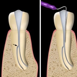 HN Dental Micro-Openers - 7