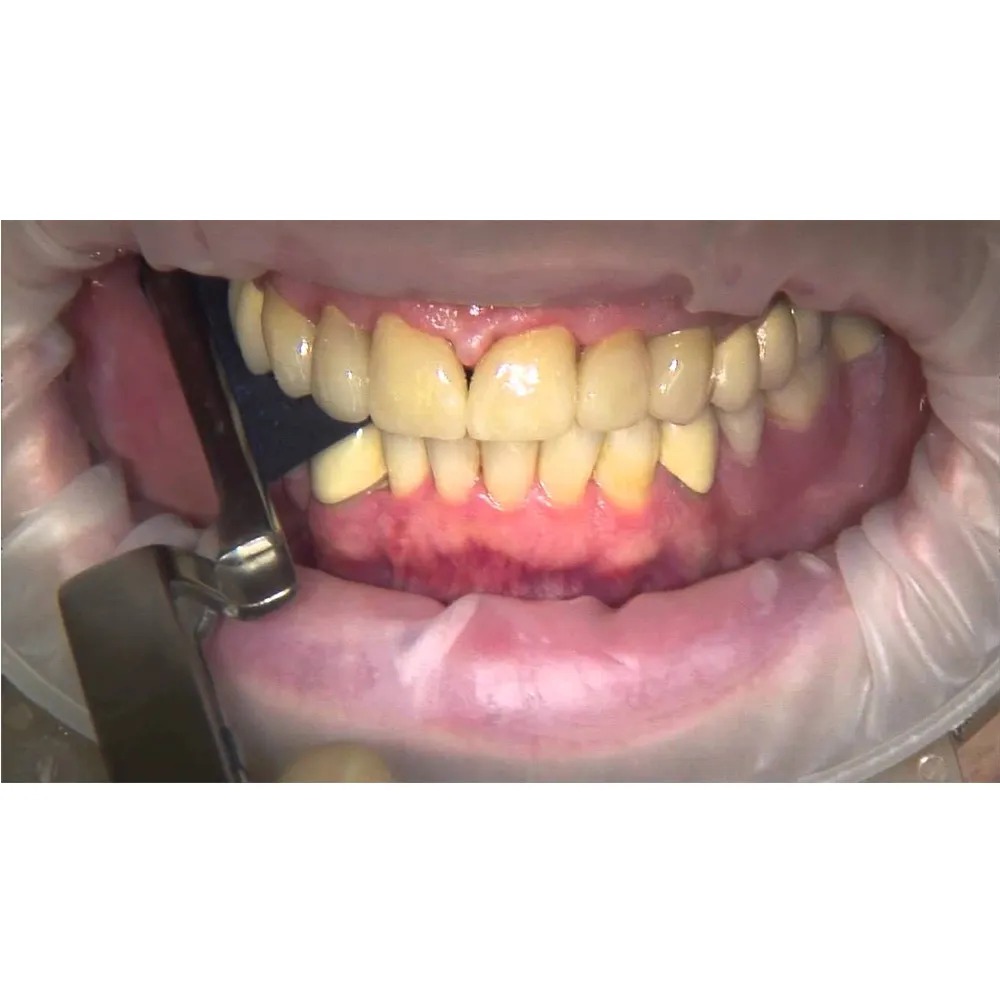 Oracraft Dental Articulating Paper Holder Miller Straight - APF2E