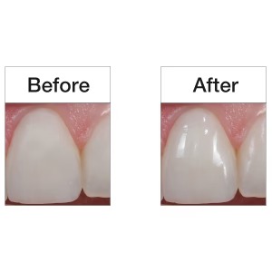 Youdent Silicone Polishers For Composite White (Pack Of 25)