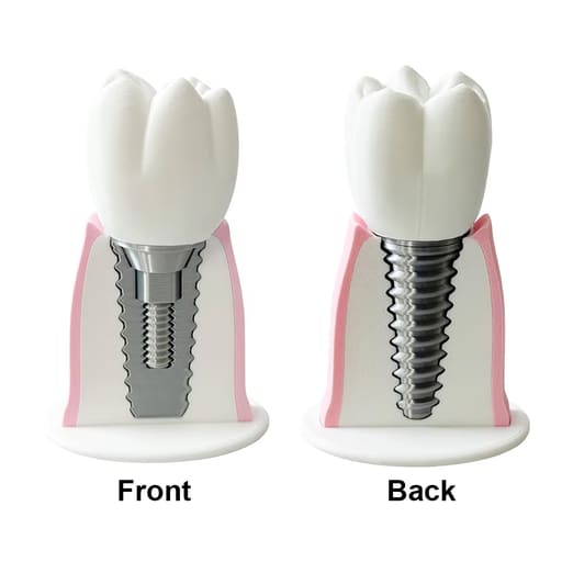 iDENTical Implant Demonstration & Explanation Model