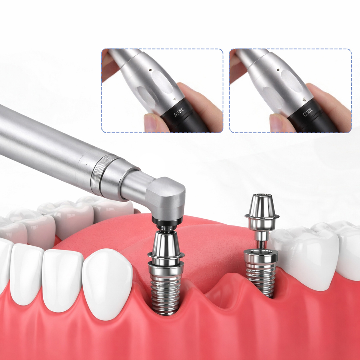 Dentaltech SD-Torque Implant Prosthetic Handpiece with 2 Drivers (SD-TQ)