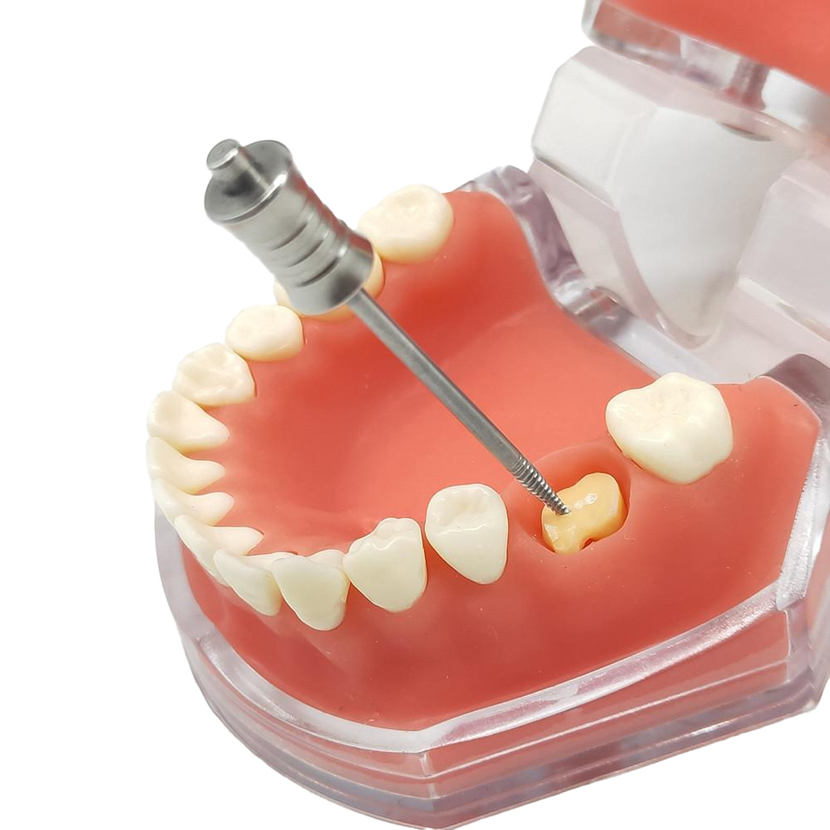 Dental Tooth Root Extractor