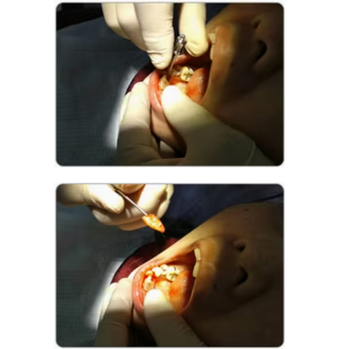 Dental Tooth Root Extractor