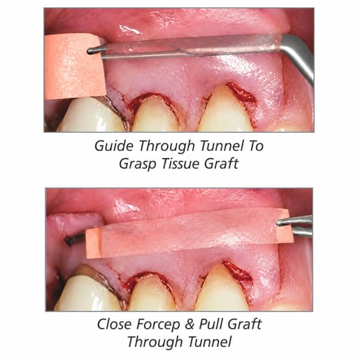 Julldent Tunneling Forcep (JULL-DENT 187)
