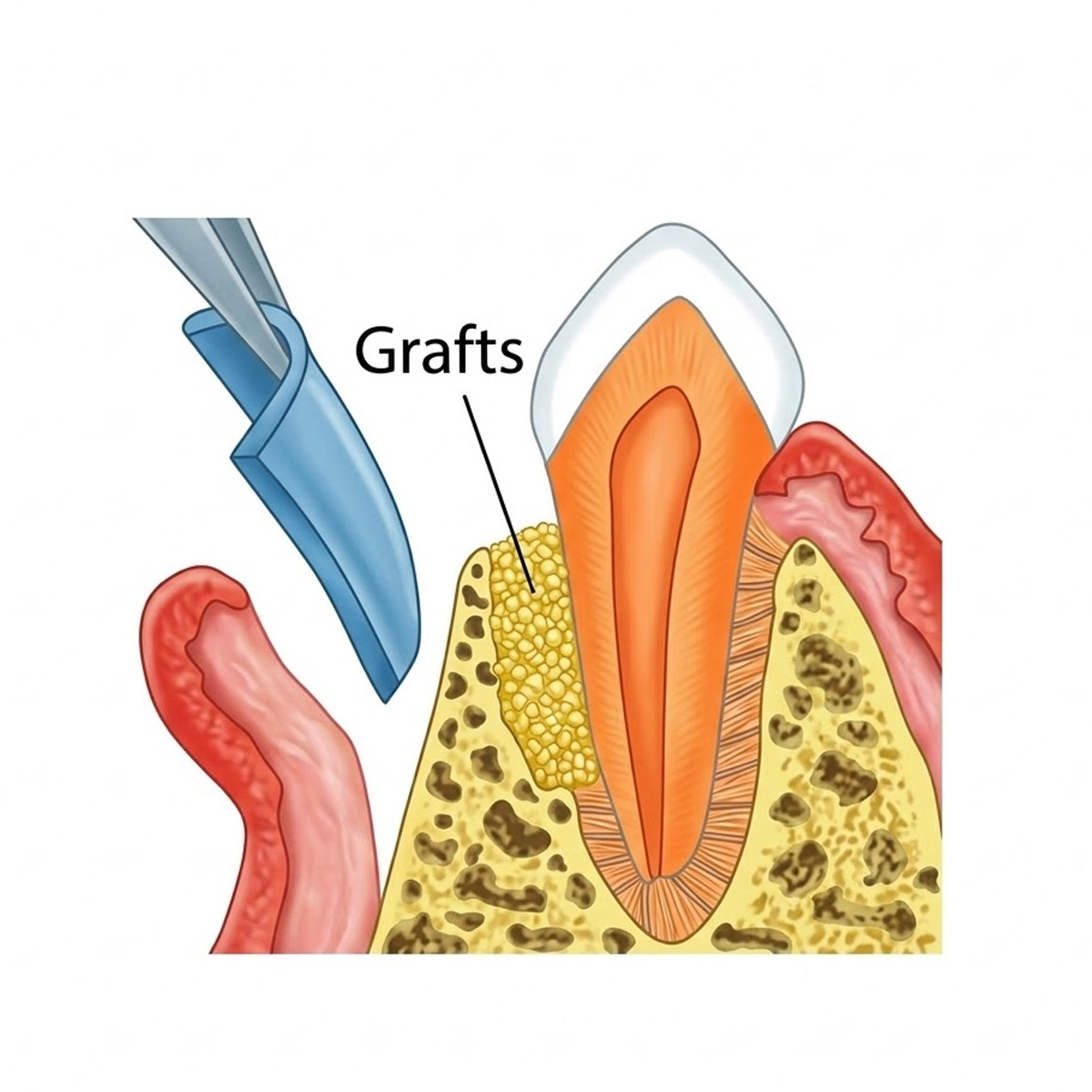 Cologenesis ColoGide GTR Membrane - Pack Of 1
