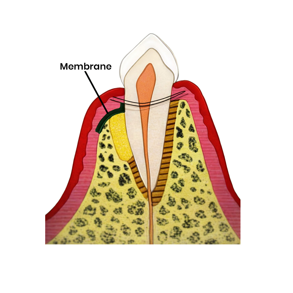 Cologenesis ColoGide GTR Membrane - Pack Of 1