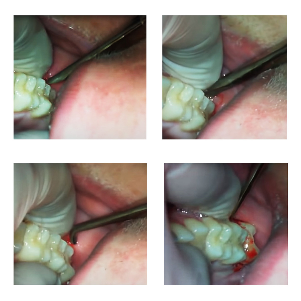 Visa Warwick James Root Elevators