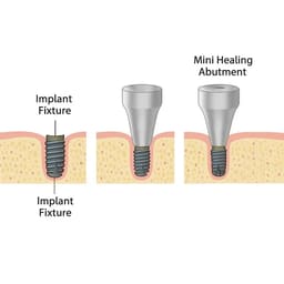 Dentaltech Healing Abutments Mini - Osstem Mini Implant Compatible - 10