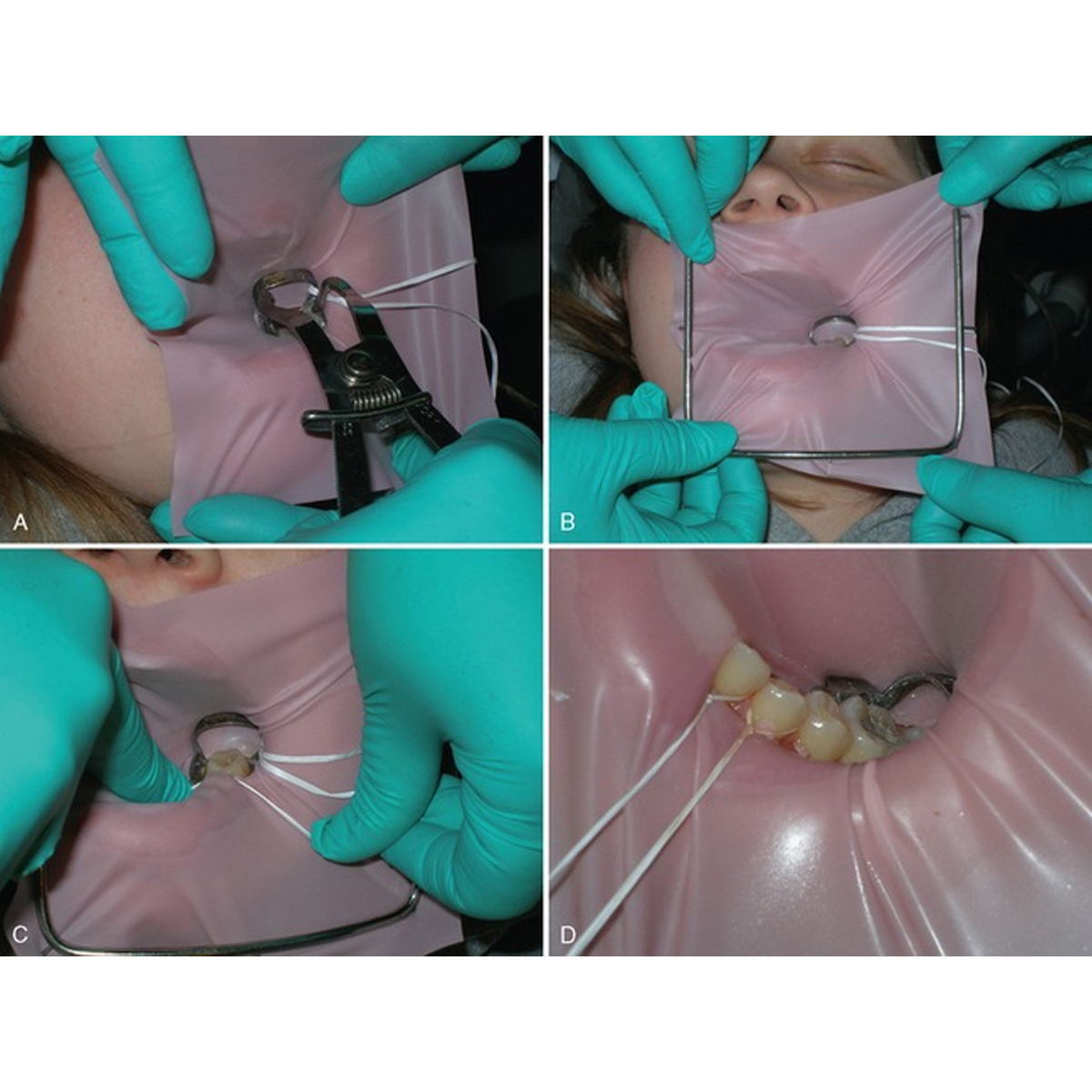 GDC Rubber Dam Clamp Paedo A4 (Rdca4)