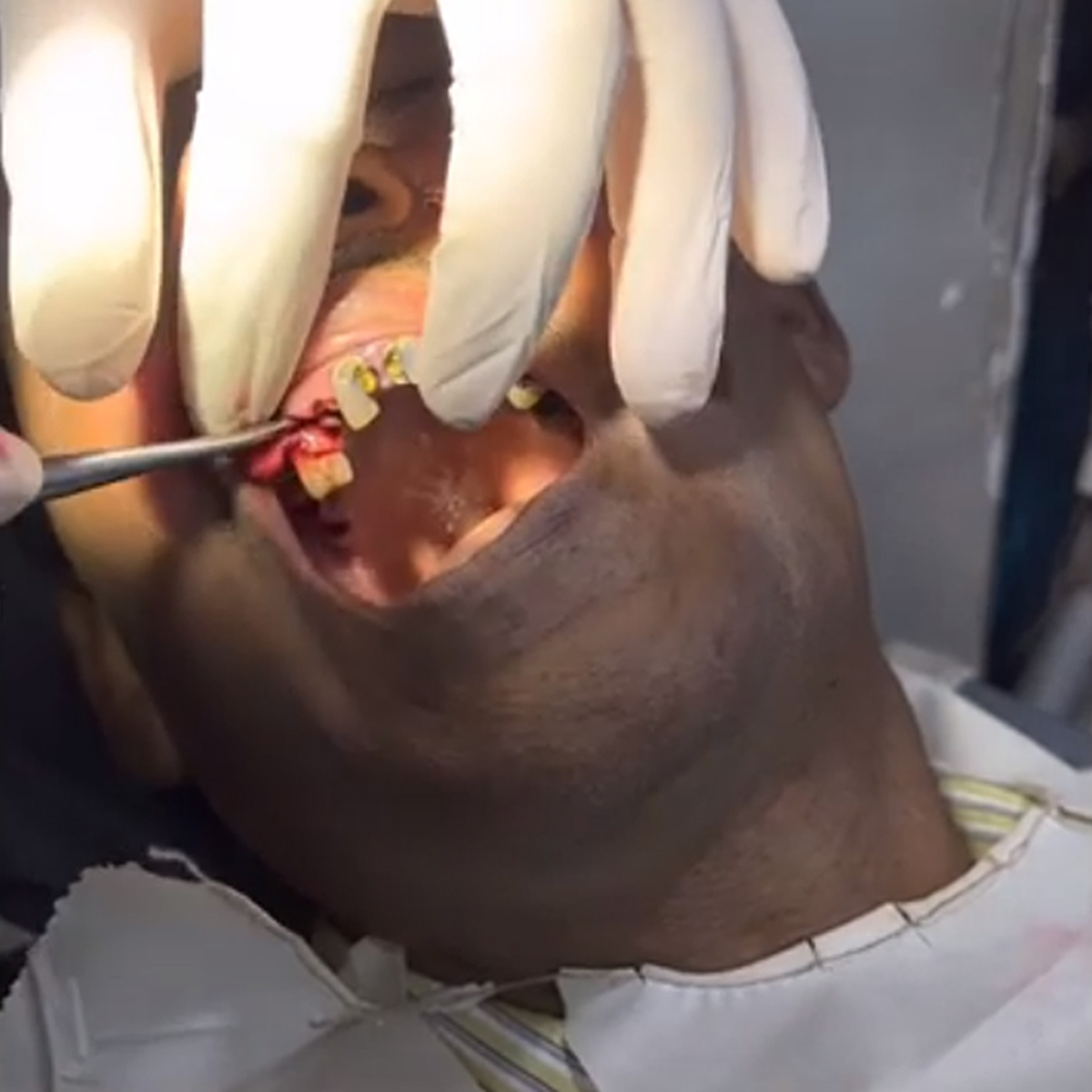 GDC Root Elevator Coupland Ea2Cp