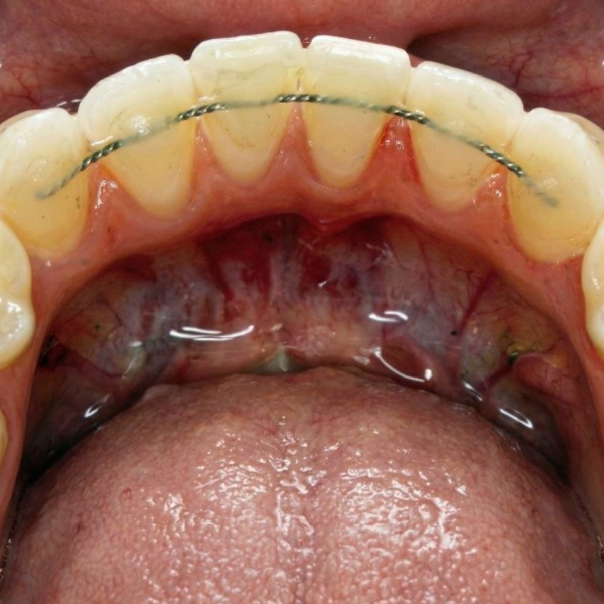 UU Ortho Straight Length Retainer Wire 0.010 x 0.028 (Pack of 10)