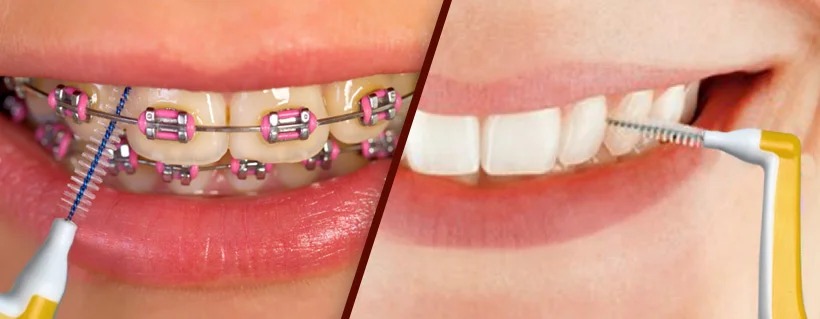 ICPA Thermoseal Proxa Interdental Brush (WS) (Pack of 12)