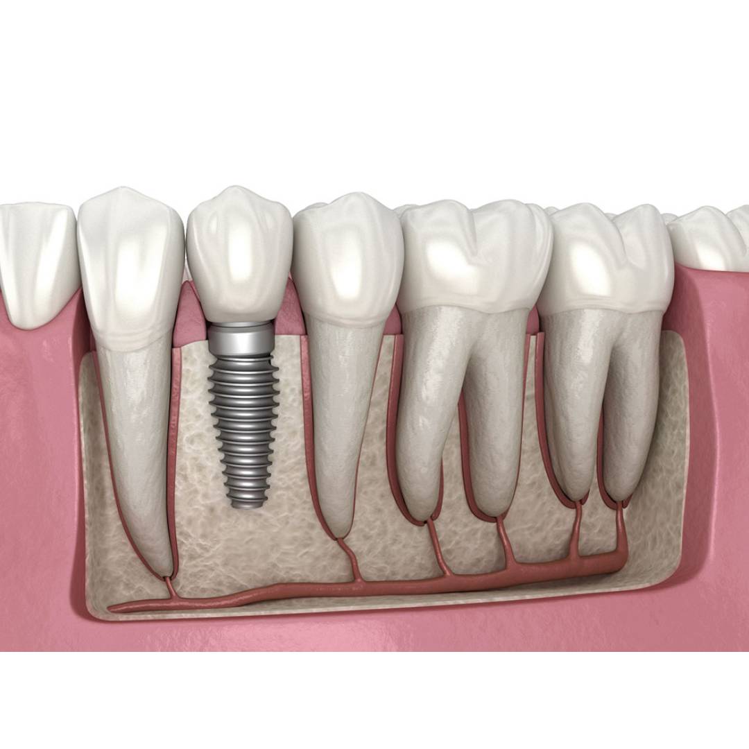Apex Konnect Dental Implants 4.20mm