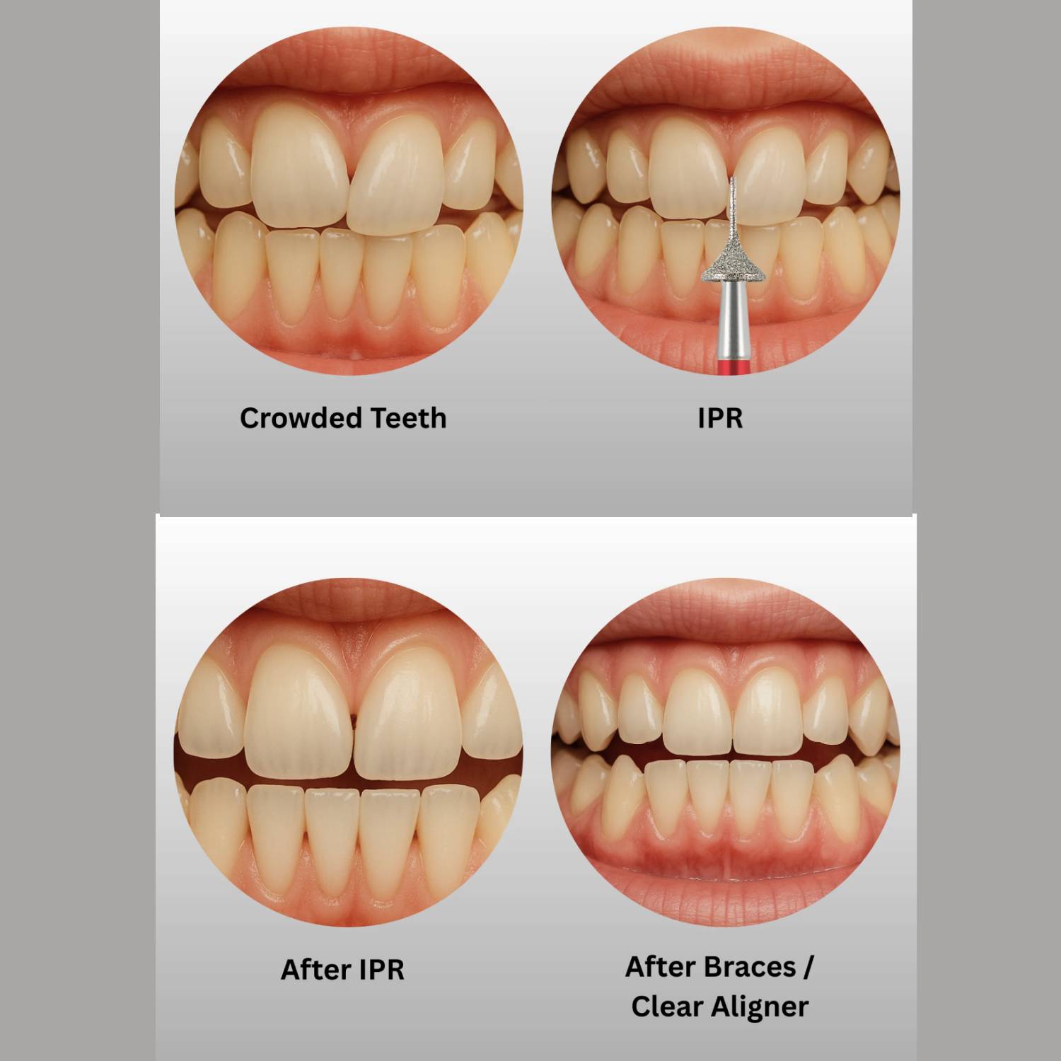 Jinzuan ProxiSure IPR Interproximal Reduction Bur Kit (Pack Of 8 Burs)