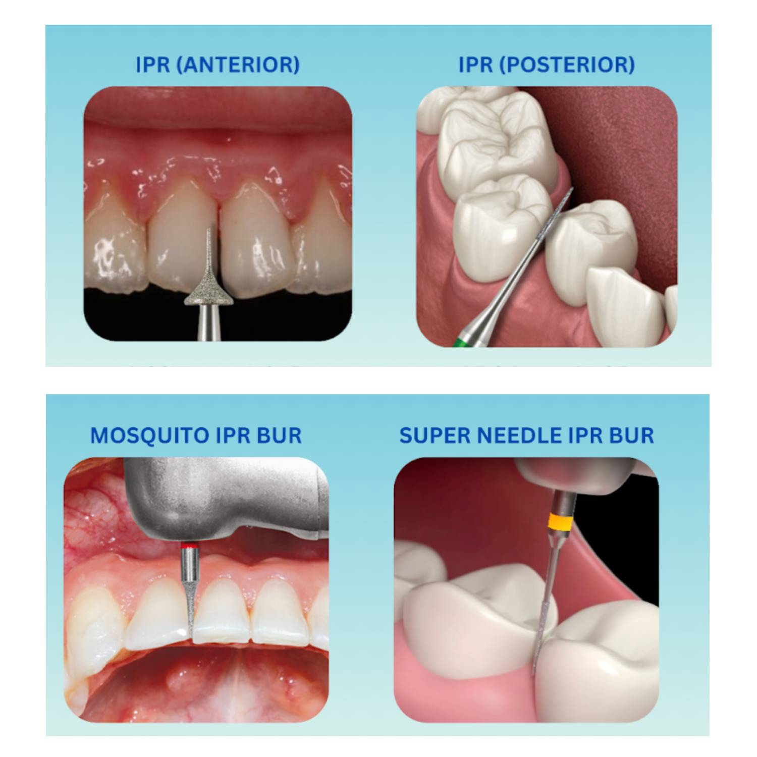 Jinzuan ProxiSure IPR Interproximal Reduction Bur Kit (Pack Of 8 Burs)