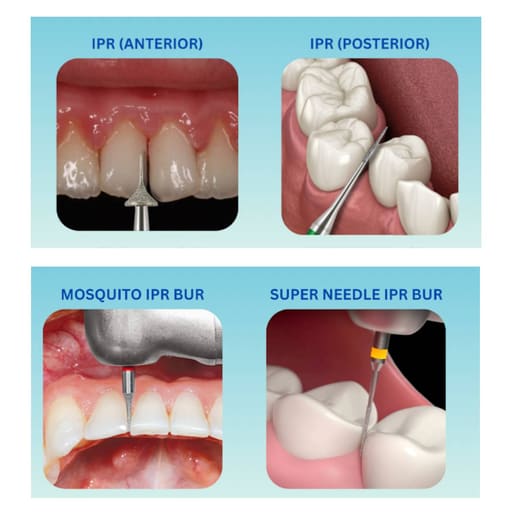 SuperEndo ProxiSure IPR Interproximal Reduction Bur Kit (Pack Of 8 Burs)