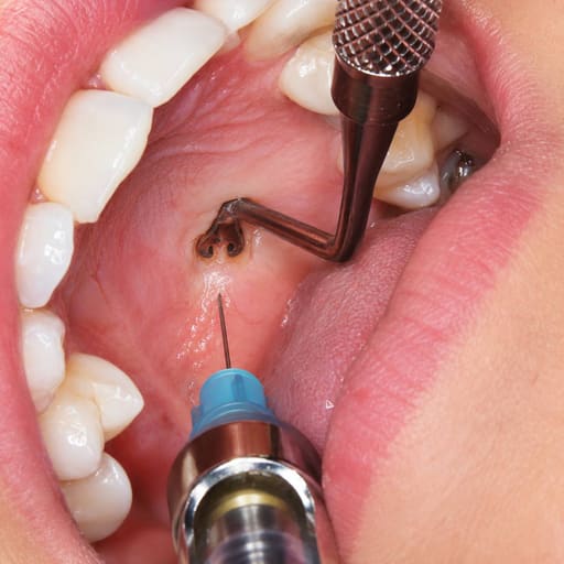 Julldent Double-Ended Palatal Anesthesia Tool (PAT)