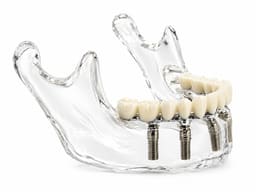 Julldent Lower Jaw Implant Model (JULL-DENT 208) - 5