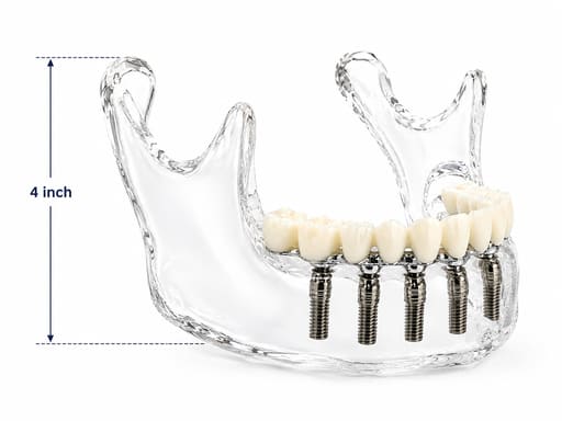 Julldent Lower Jaw Implant Model (JULL-DENT 208)