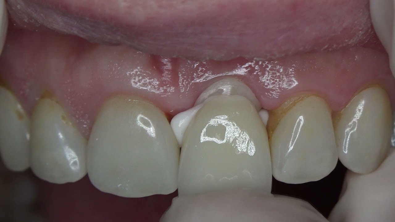 Prime Dental Prime Cem Luting Type 1 GIC