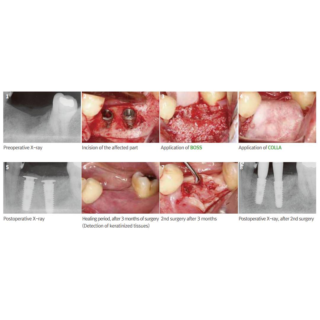 MedPark Colla Resorbable Collagen Membrane | Soft Type | 10mmX20mm