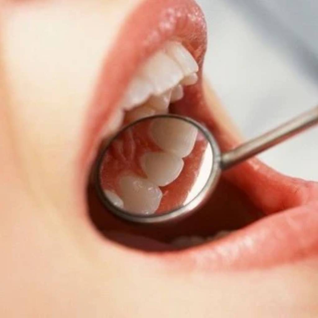 Waldent Rhodium Coated Mouth Mirror Tops (Pack of 1)