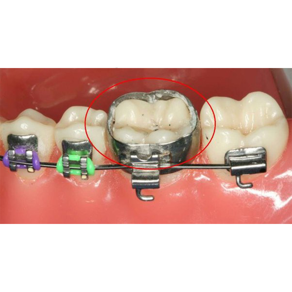 Syden Preformed Molar Band With Prewelded Mbt Buccal Convertible Tubes U3/L2 Pack of 4 Pcs-40