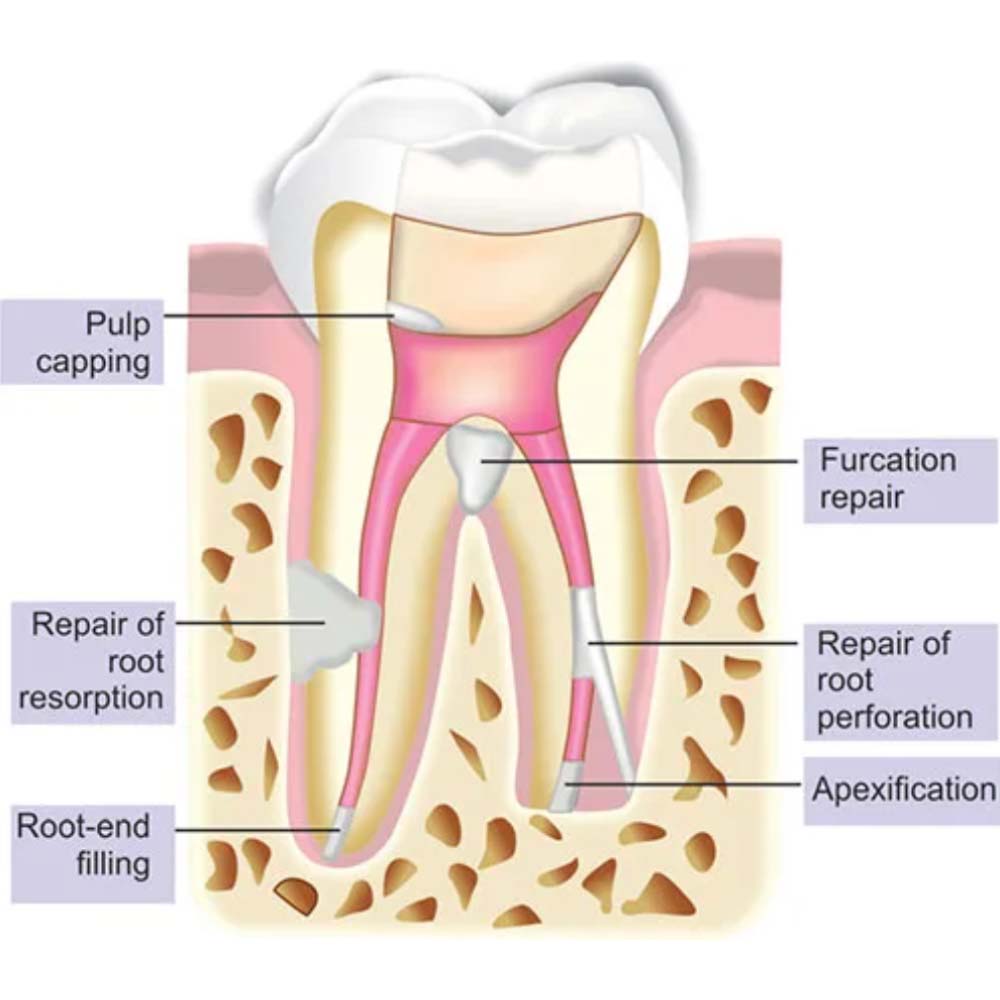 Kids-e-Dental E-MTA 1gm (Short Expiry 08-2026)