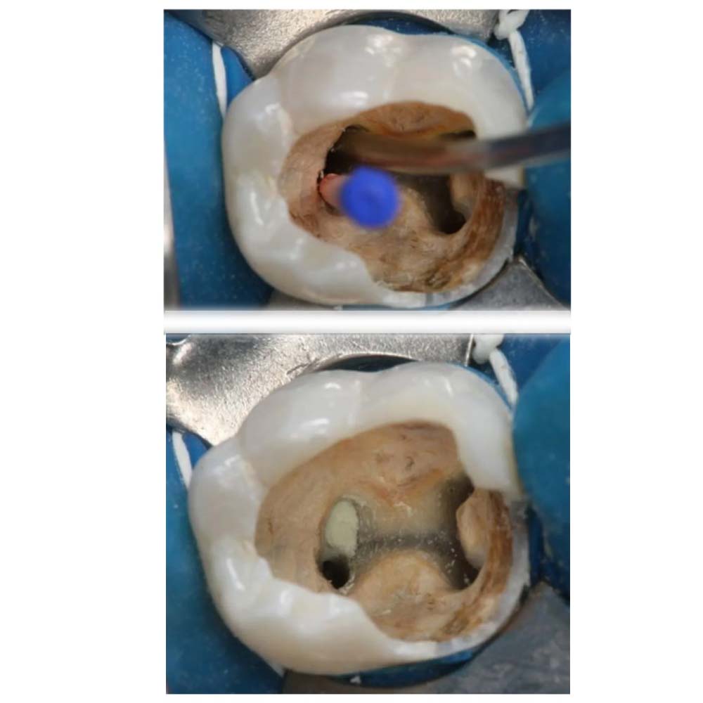 Kids-e-Dental E-MTA 1gm (Short Expiry 08-2026)