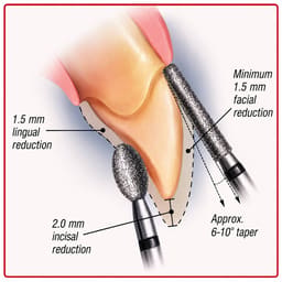 NewDiamond Porcelain Preparation & Repair FG Airotor Bur Kit - Pack of 10 Burs (FG-109) - 5