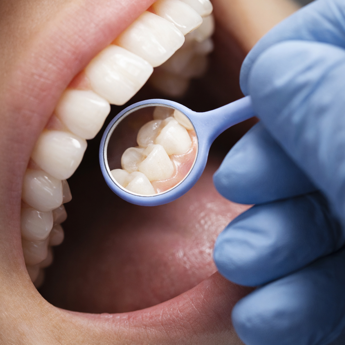 ET Dental Relax Mouth Mirror (Single Sided) - Pack of 1