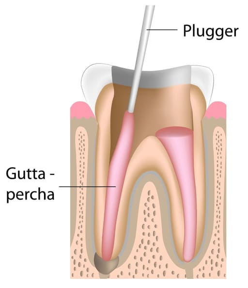 Waldent Root Canal Pluggers Luks - Hollow