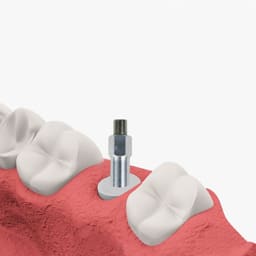 DentalPlant Osstem GSII Compatible SmartPegs - 5