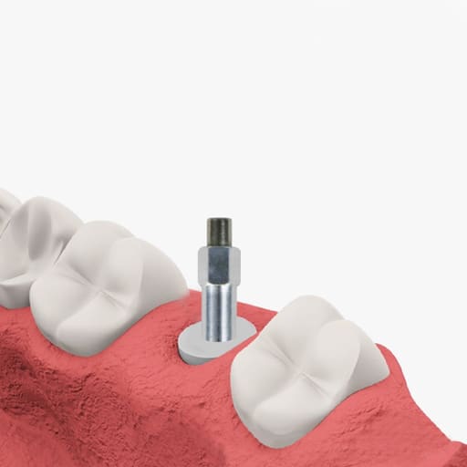 DentalPlant Adin CloseFit RP Compatible SmartPeg