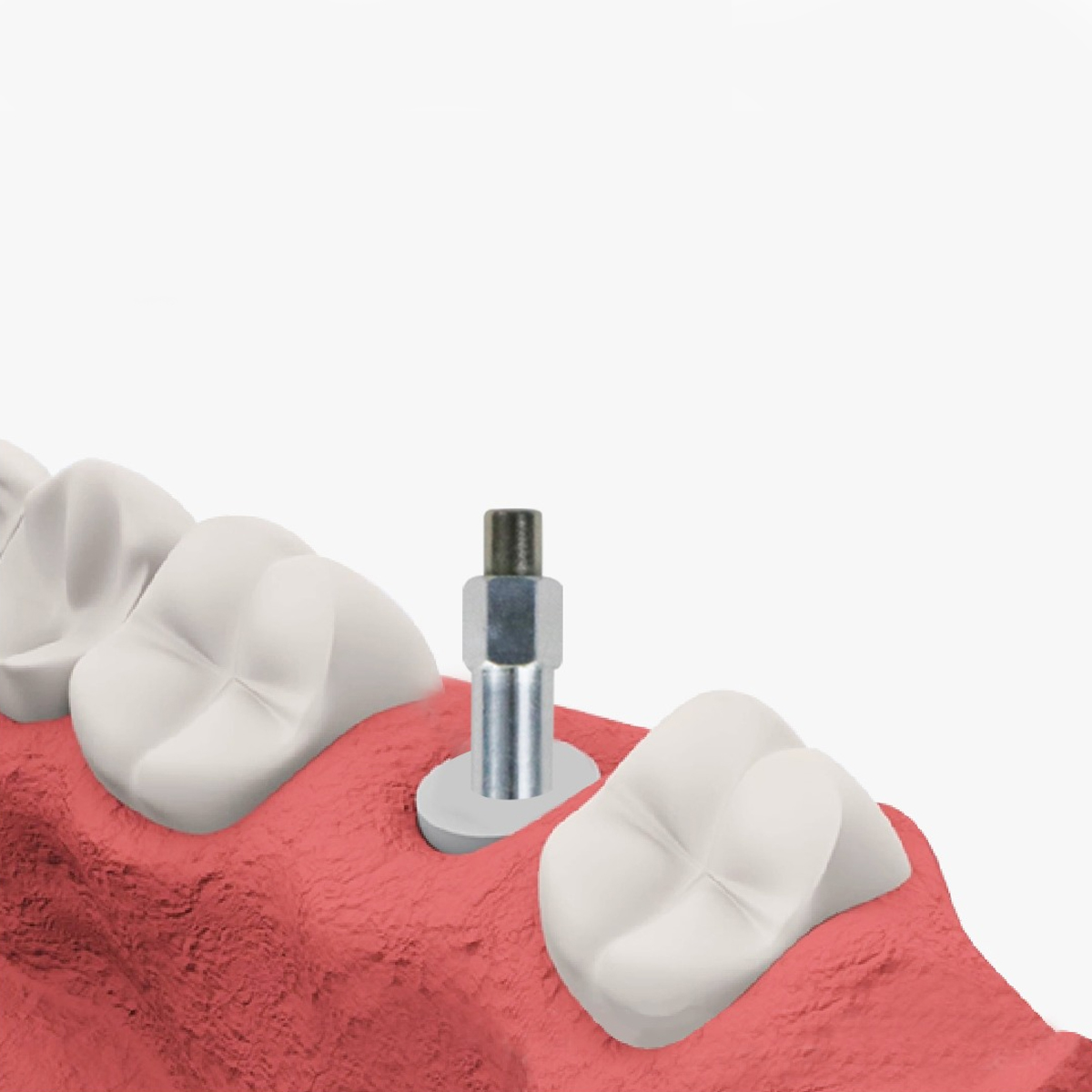 DentalPlant Nobel Biocare Compatible SmartPegs