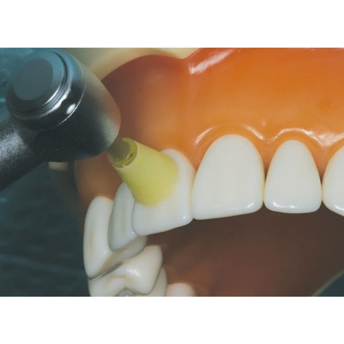 MIK ZircPolish Professional Monolithic Zirconia Polishing Kit